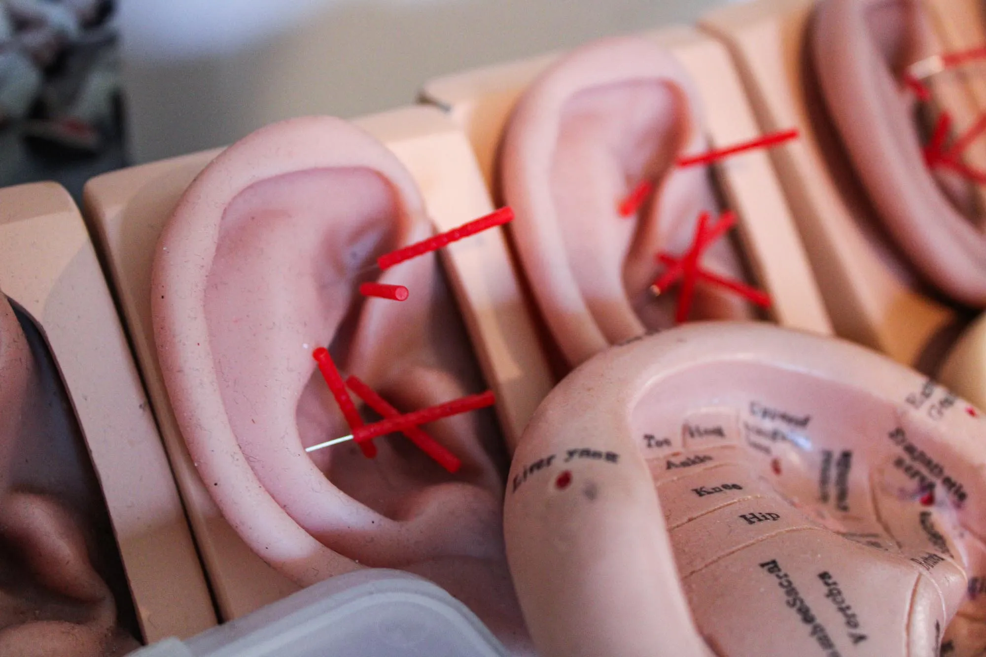 Washington Heights: Ear Acupuncture for Stress