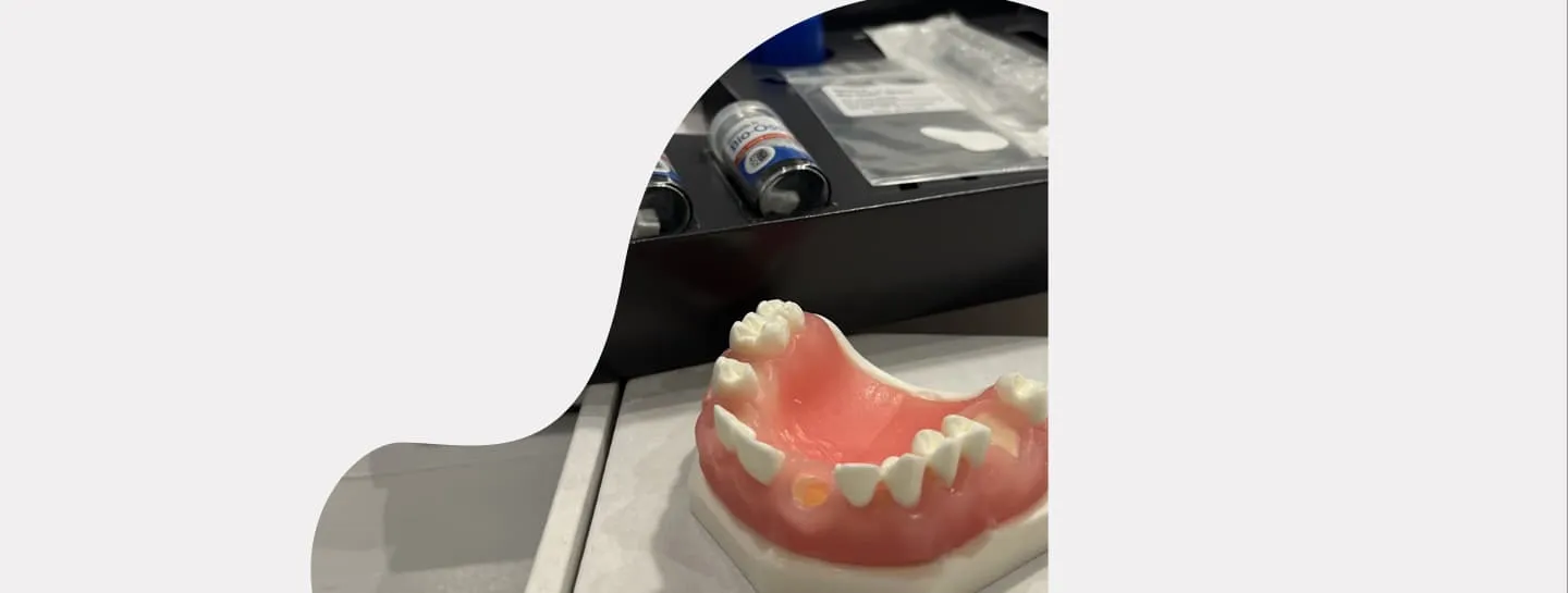 Alveolar ridge preservation for pontic site development and implant placement